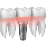 Импланты зубов Может ли искусственный корень не прижиться