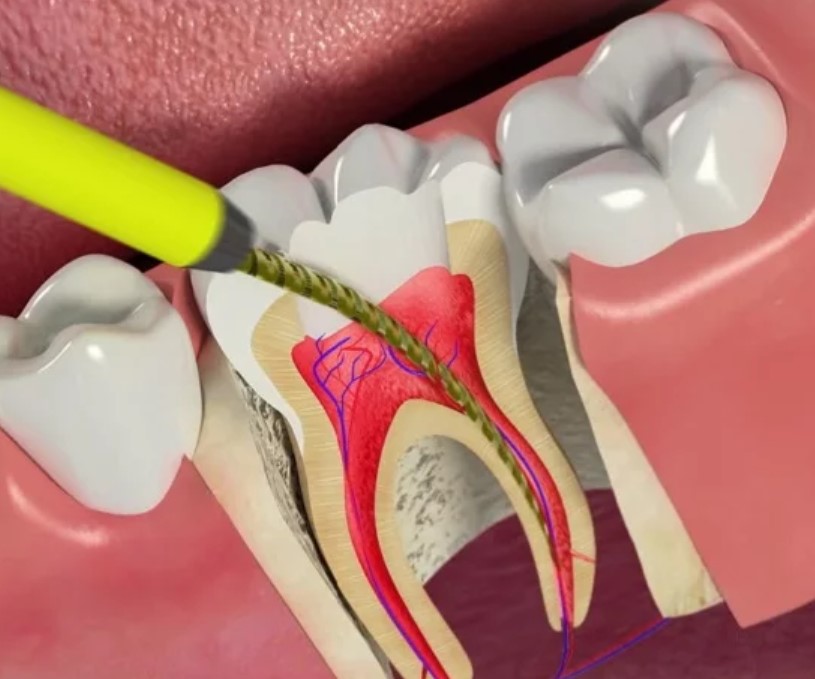 Удаление нерва зуба последствия