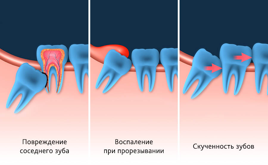 удаление зуба мудрости в иркутске